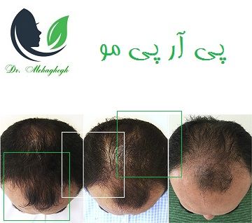 پی آر پی مو