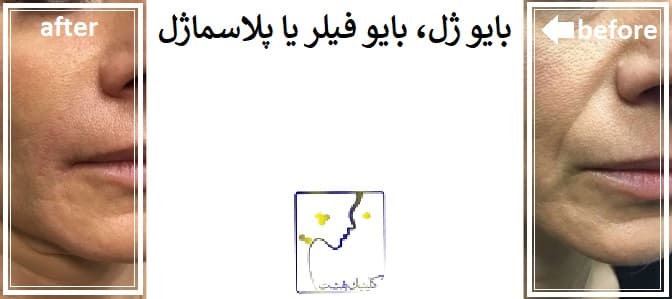 بایو ژل، بایو فیلر یا پلاسماژل