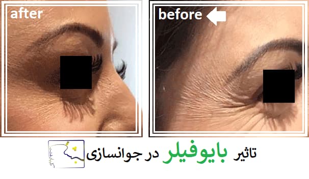 تاثیر بایوفیلر در جوانسازی