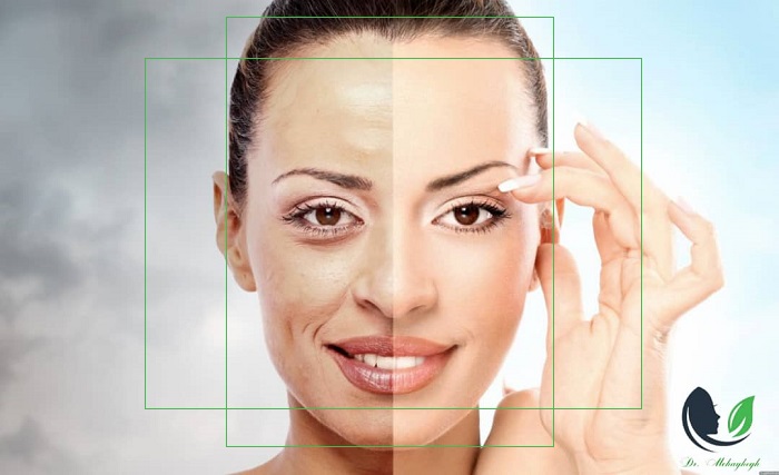 بوتاکس همیشه توصیه نمیشود