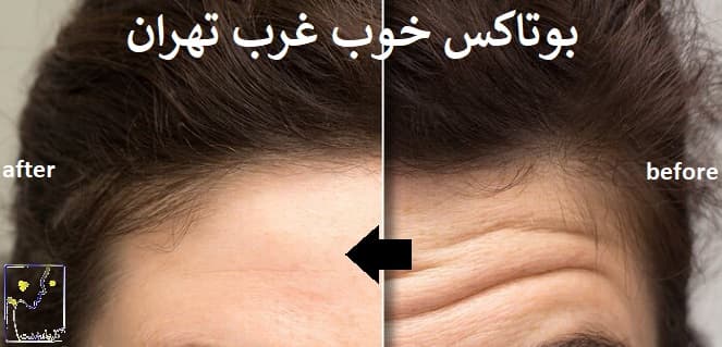 بوتاکس خوب غرب تهران