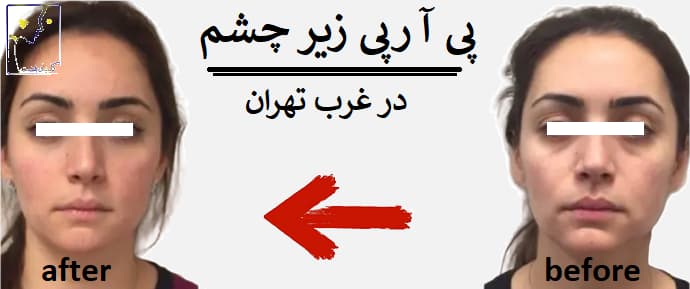 پی آر پی زیر چشم در غرب تهران