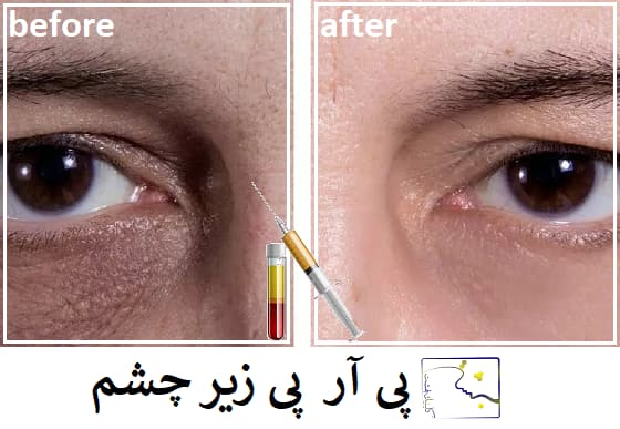 پی آر پی زیر چشم