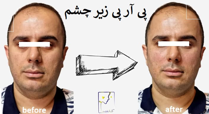 پی آر پی زیر چشم