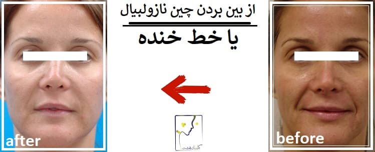 از بین بردن چین نازولبیال یا خط خنده