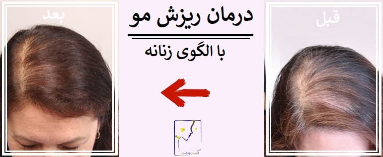 درمان ریزش مو با الگوی زنانه
