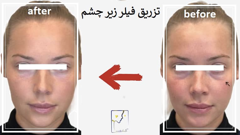 تزریق فیلر زیر چشم