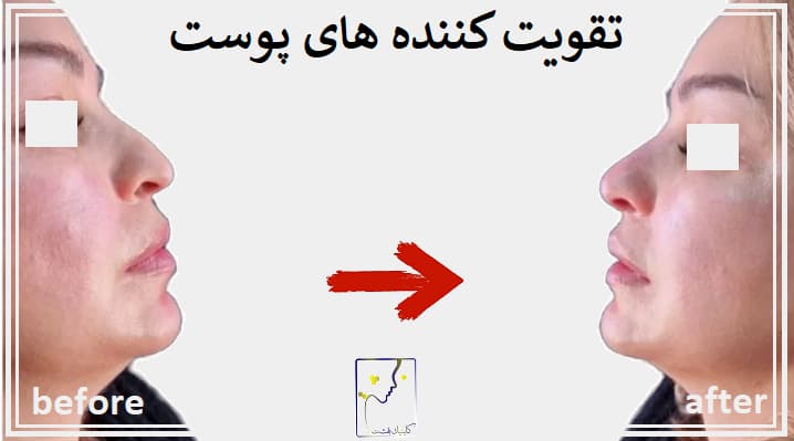 تقویت کننده های پوست