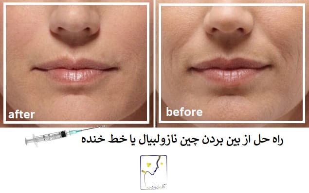راه حل از بین بردن چین نازولبیال یا خط خنده