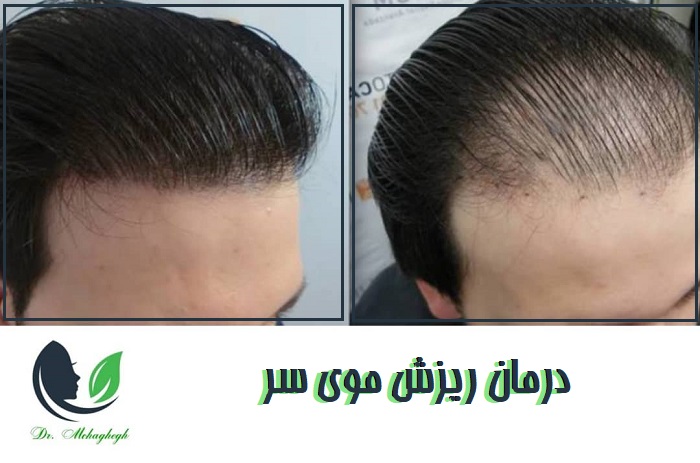 روش های درمان ریزش موی سر