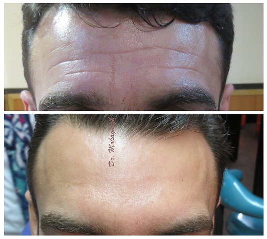 تزریق بوتاکس