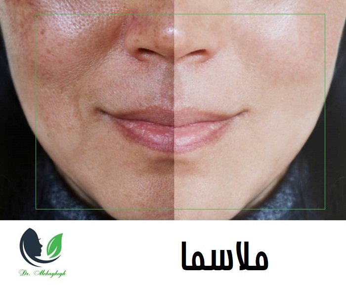 ملاسما