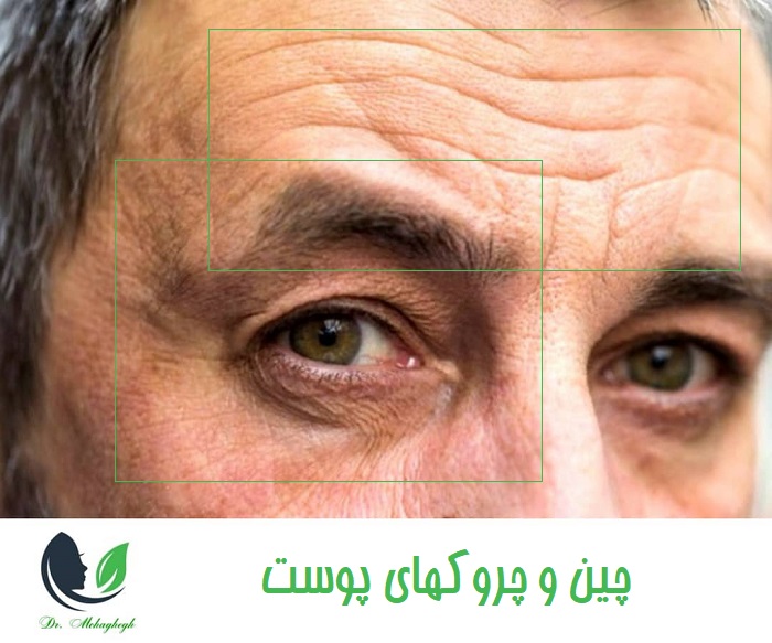 چین و چروکهای پوست