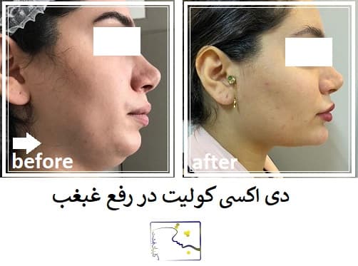 دی اکسی کولیت در رفع غبغب