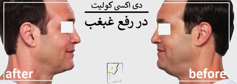 دی اکسی کولیت در رفع غبغب
