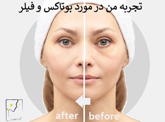 تجربه من در مورد بوتاکس و فیلر
