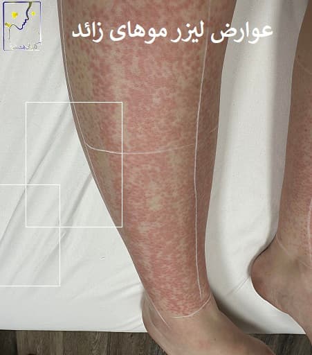 عوارض لیزر موهای زائد