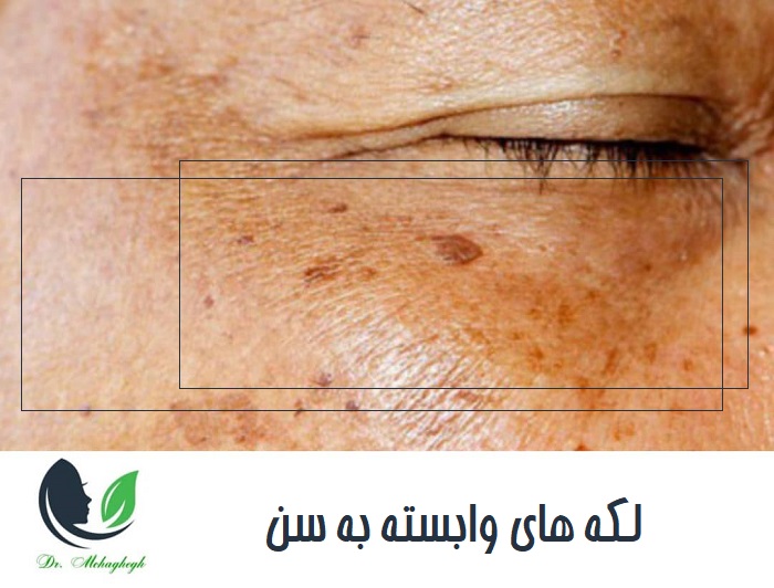 لکه های وابسته به سن
