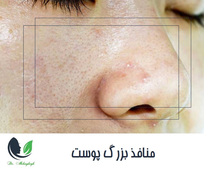 منافذ بزرگ پوست