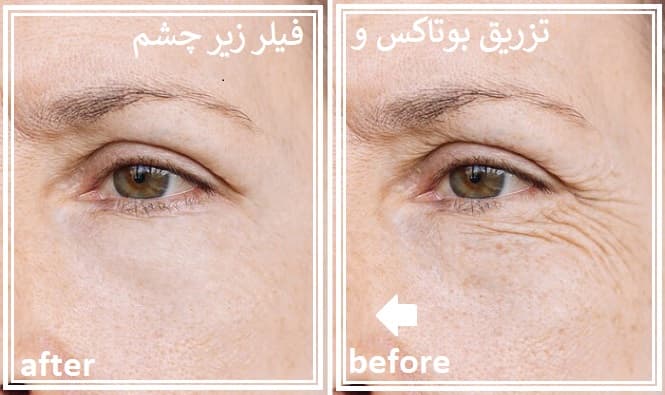 تزریق بوتاکس و فیلر زیر چشم