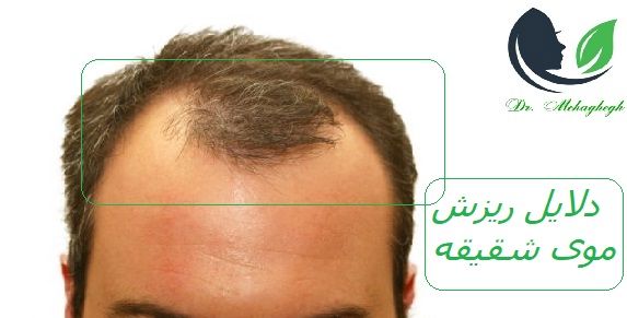 دلایل ریزش موی شقیقه
