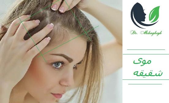 موهای شقیقه