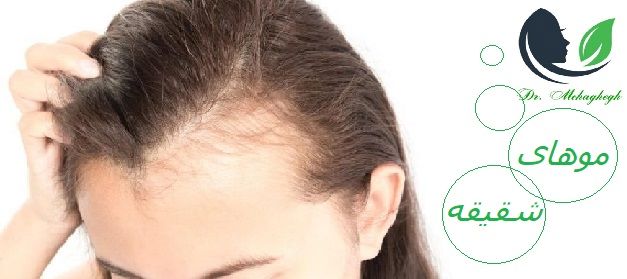موهای شقیقه و ریزش آن