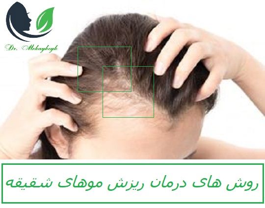 روش های درمان ریزش موی شقیقه