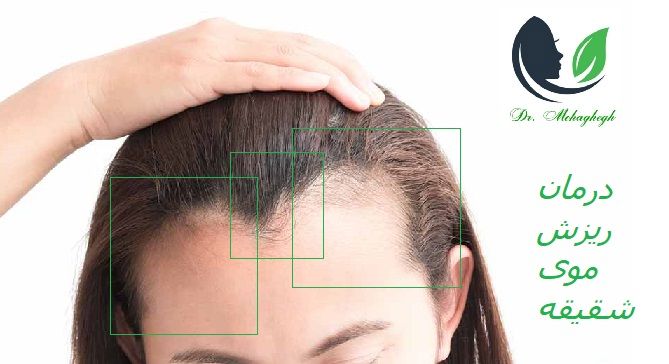 ریزش موی شقیقه در بانوان