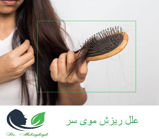 علل ریزش مو