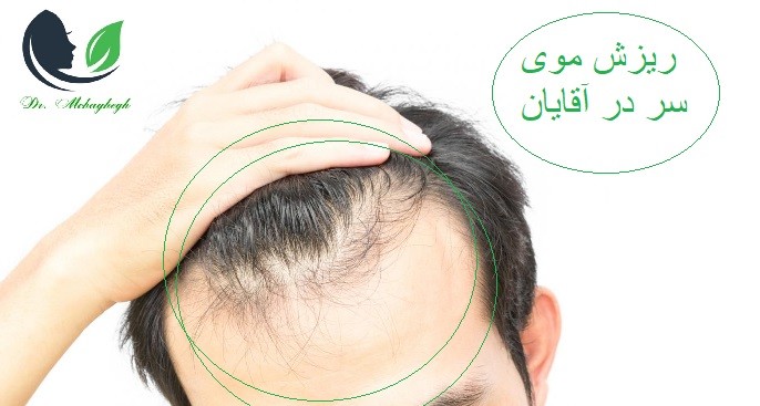 ریزش موی اقایان