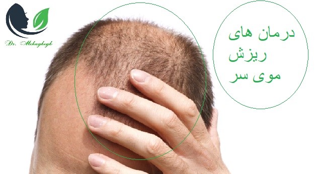 درمان های ریزش موی سر