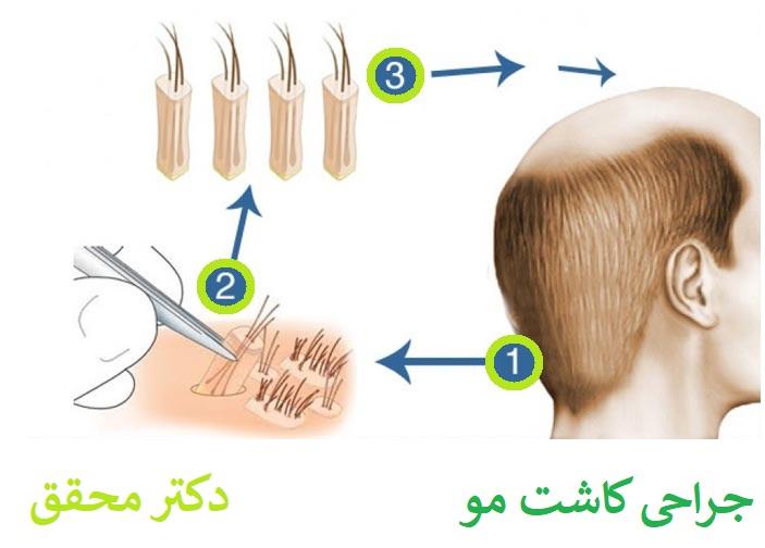 جراحی کاشت مو 
