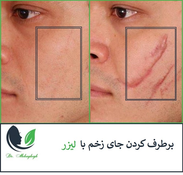 لیزر برای جای زخم و بخیه
