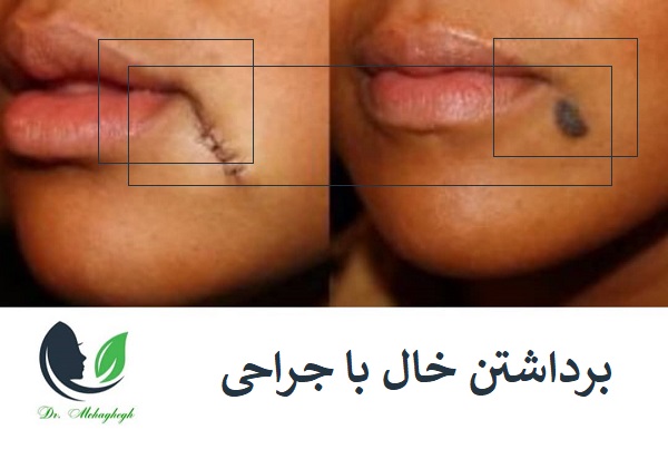 برداشتن خال با چراحی