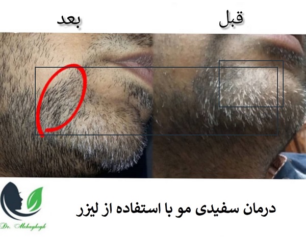 لیزر مو برای درمان موهای سفید( الکترولیز)