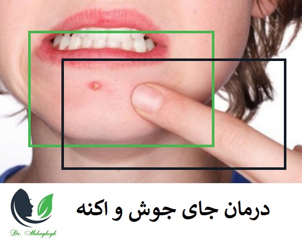 چگونگی درمان جای جوش و خود آکنه و جوش