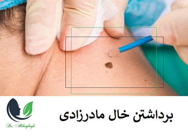 برداشتن خال های مادرزادی