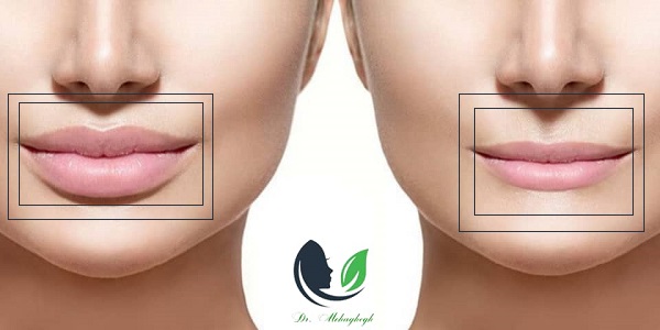 تزریق ژل لب