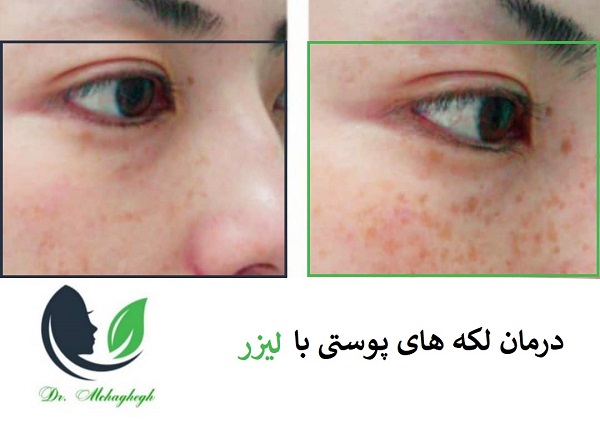 لیزر برای لک پوستی
