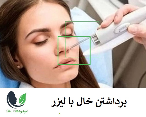 برداشتن خال با لیزر