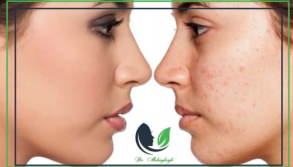 بهترین دکتر برای درمان جای جوش وآکنه