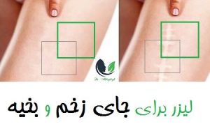 لیزر برای جای زخم و بخیه