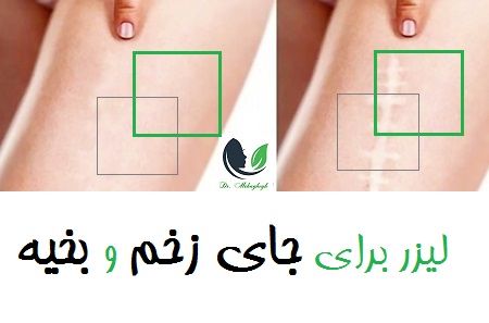 لیزر برای جای زخم و بخیه