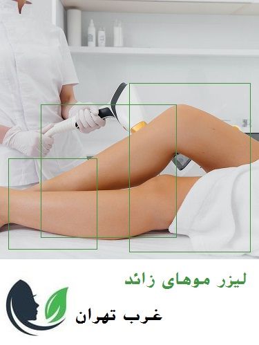 لیزر موهای زائد