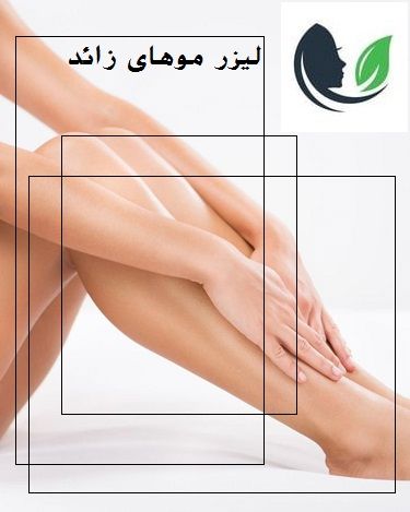 لیزر موهای زائد