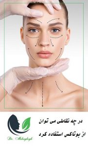 در چه نقاطی میتوان از بوتاکس استفاده کرد