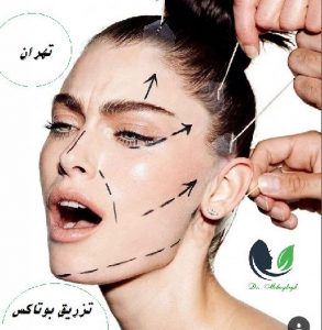 تزریق بوتاکس
