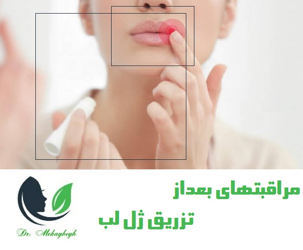 مراقبت های بعد از تزریق ژل لب روسی در تهران 