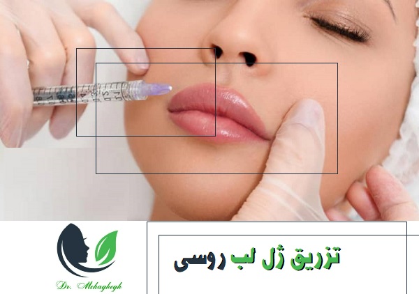 تزریق ژل لب روسی در تهران